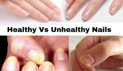 Healthy Vs Unhealthy Nails